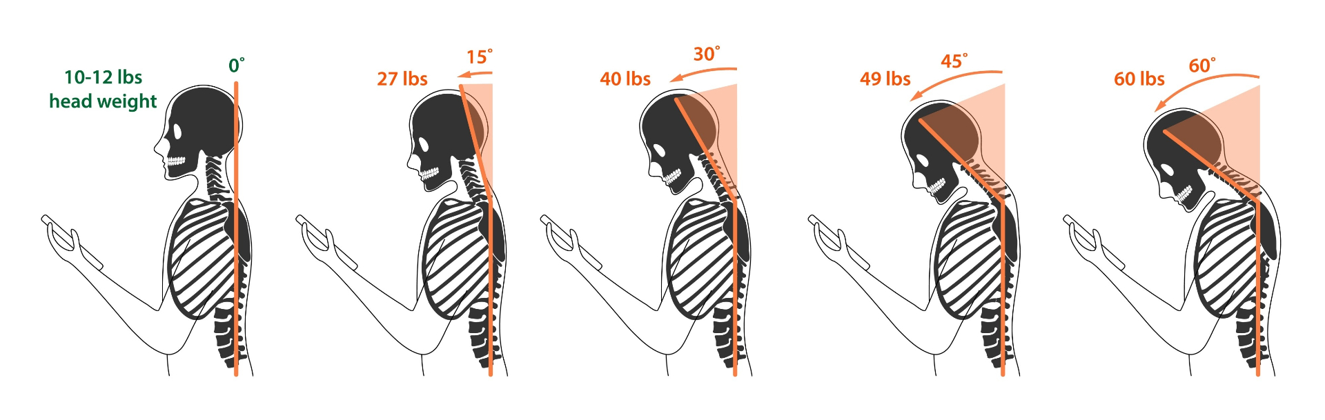 Diagram showing how neck angle affects weight on cervical spine - from 10-12 lbs at 0 degrees to 60 lbs at 60 degrees